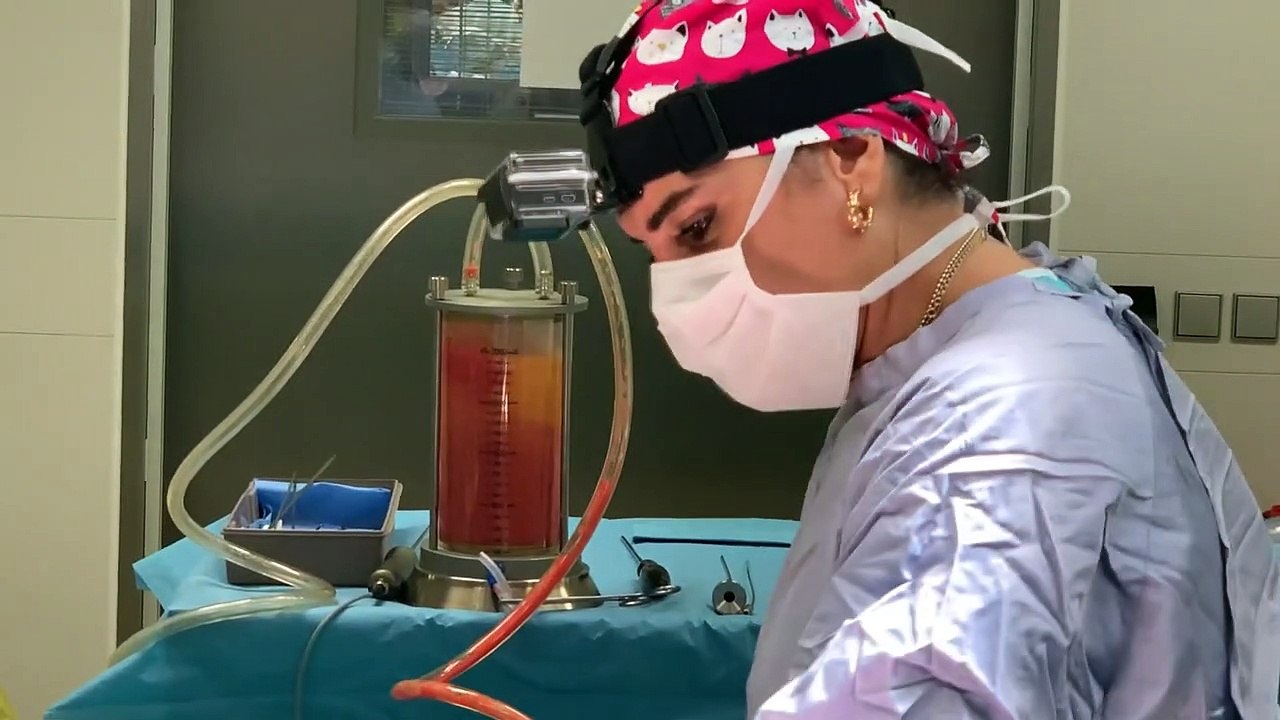 Yağ Aldırma | Vaser Liposuction (Liposakşın) Ameliyatı | Önce&Sonra Sonuçları