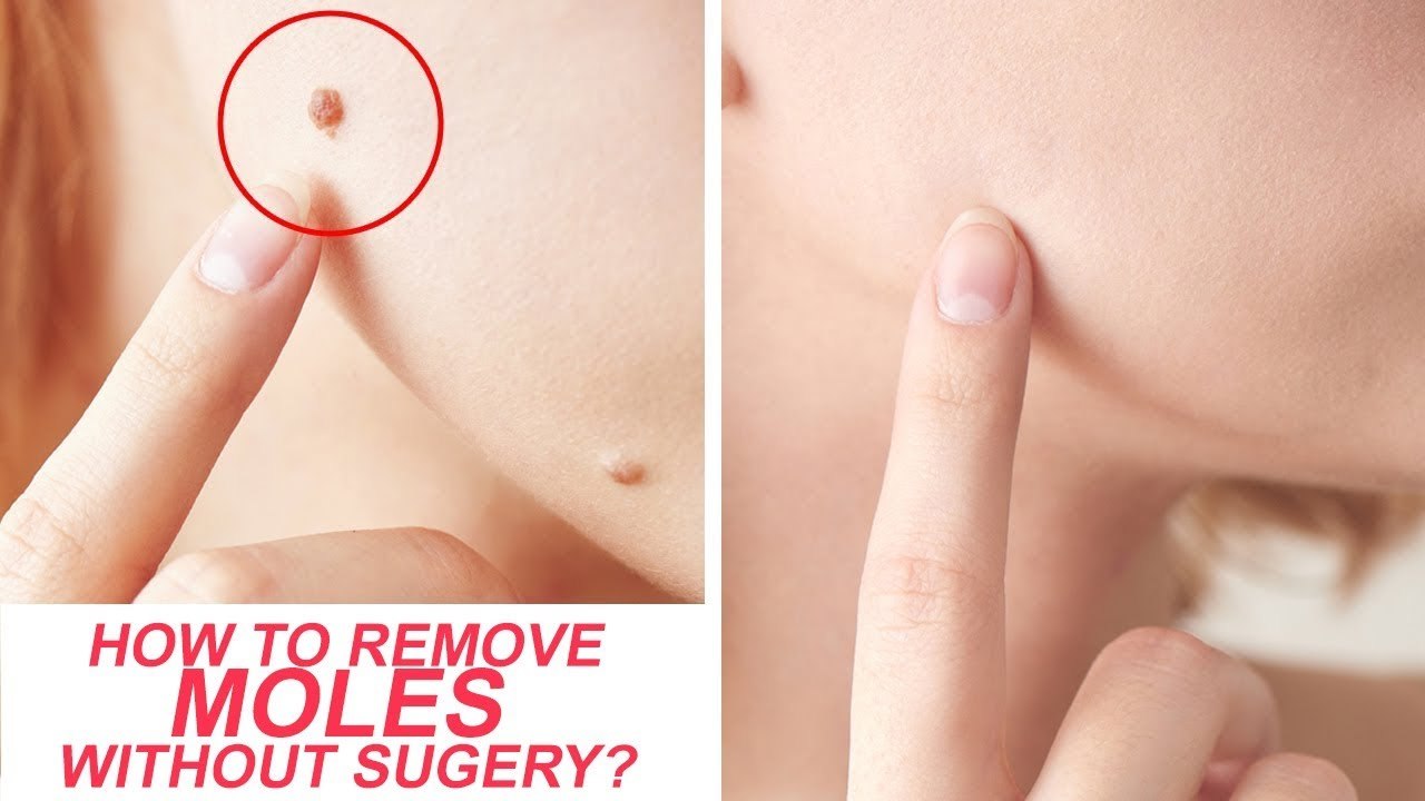 How to Remove Moles Without Surgery | Health Tips