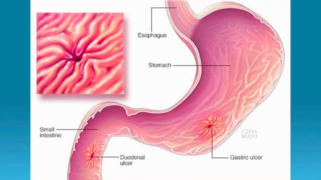 bd-ulceras-gastricas-201120