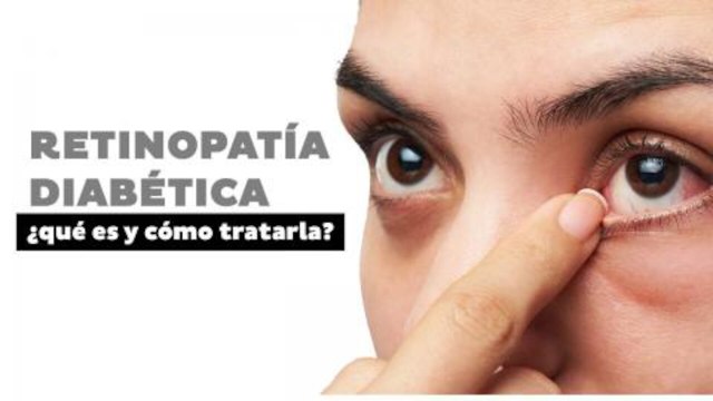 Retinopatía diabética, ¿qué es y cómo tratarla? | Salud180