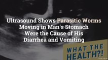 Ultrasound Shows Parasitic Worms Moving in Man’s Stomach Were the Cause of His Diarrhea an