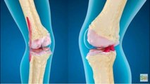 Lesiones más comunes en rodillas y pies, ¿Cómo evitarlas?