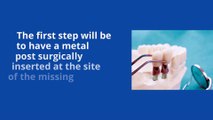 Dental Implants in Ajax: Procedure, Placement, Cost | Singer Dental