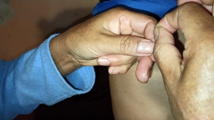 Cómo eliminar verrugas muy fácil (mezquinos)