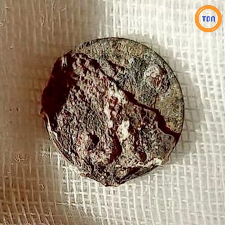 Depuis 53 ans, Il avait une pièce de monnaie... coincée dans le nez