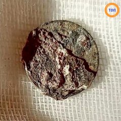 Depuis 53 ans, Il avait une pièce de monnaie... coincée dans le nez