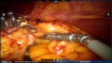 Robotic Sleeve Gastrectomy for Morbid Obesity Patient performed by Dr.S.C Hirides MD MSc PhD FACS 2018