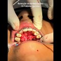 Remoção de dentes retidos