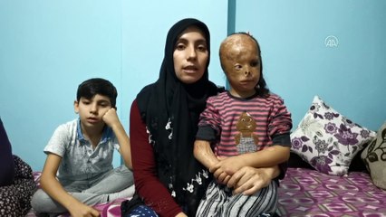 KOCAELİ  - Bebekken yüzü yanan 5 yaşındaki Dilara ameliyat olmak için yardım bekliyor