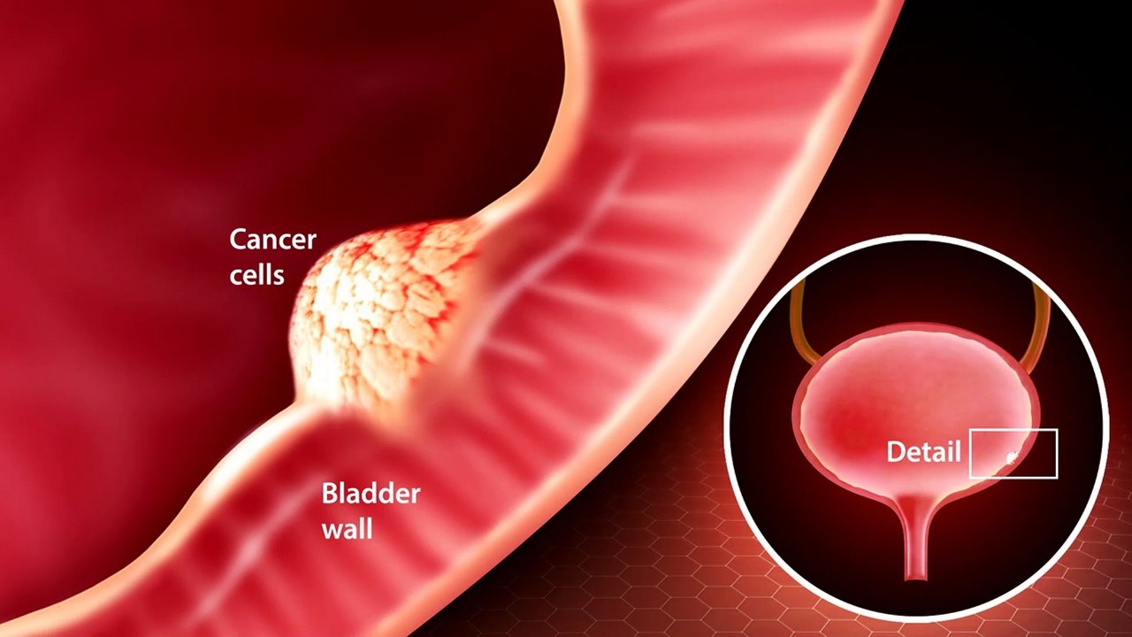 What Is Bladder Cancer video Dailymotion