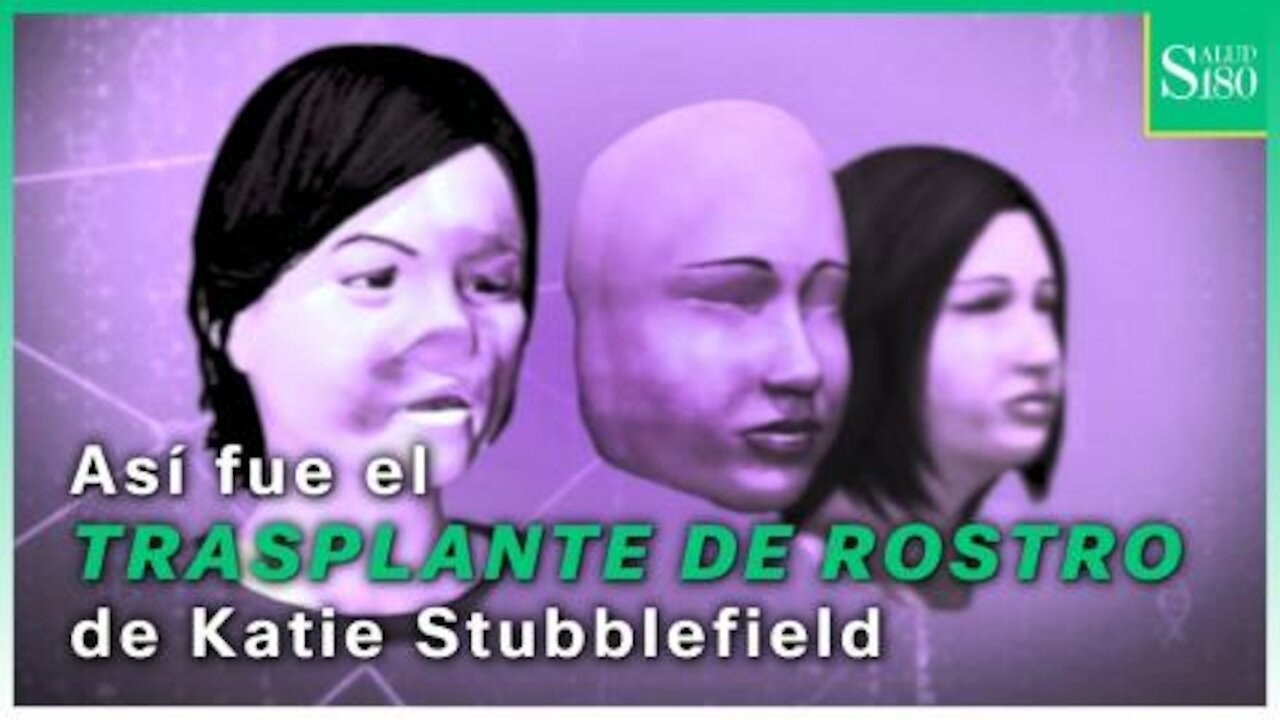 Así fue el trasplante de rostro de Katie Stubblefield | Salud180
