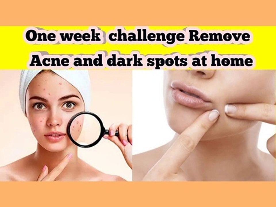 how to remove Acne and dark spots in one week at home | How to remove acne quickly
