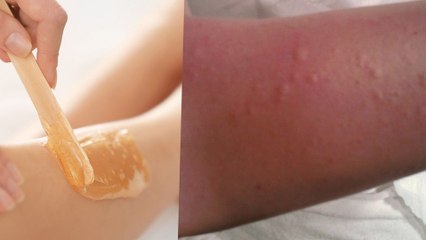 Waxing कराने के बाद आपको भी हो जाते हैं Rashes तो करे ये काम | Boldsky