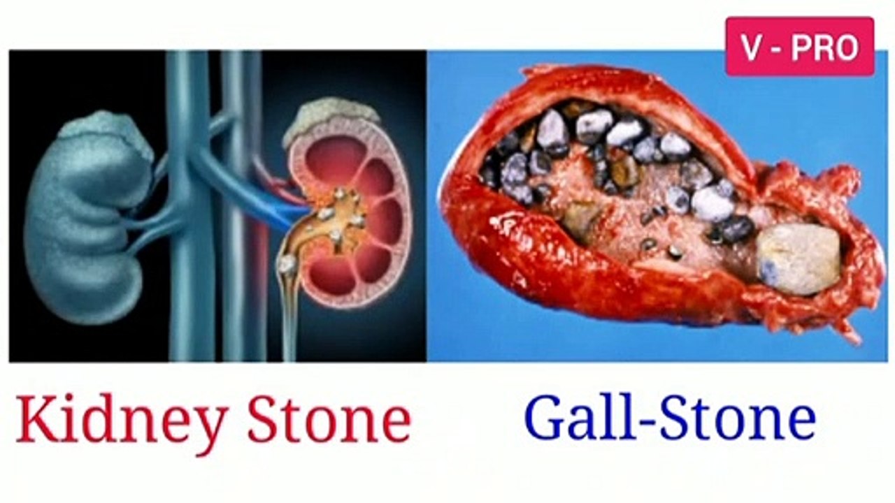 Kidney /  Gallbladder Stone's Treatment | Dr Biswaroop Roy Chowdhury in Hindi