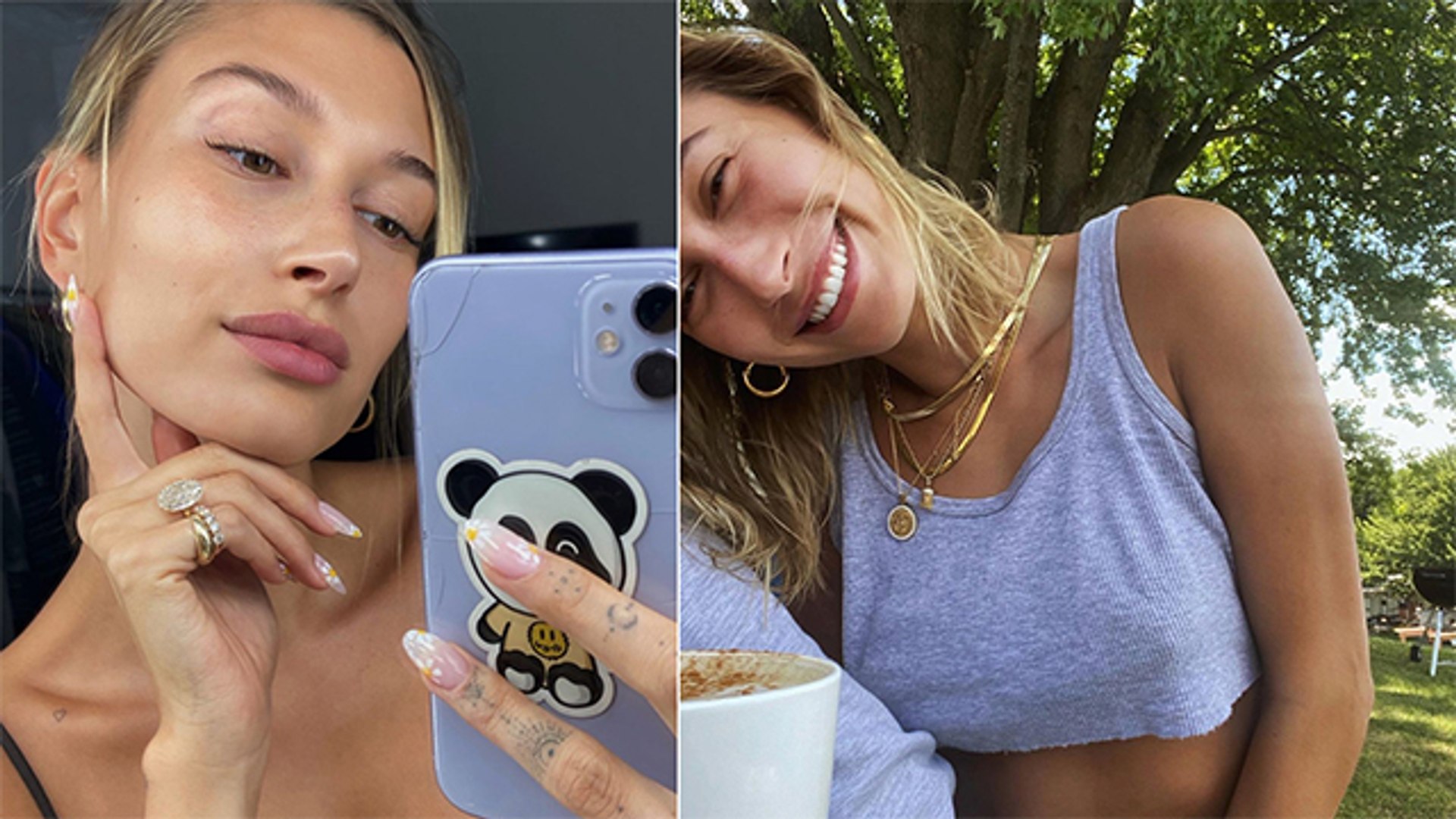 Hailey Bieber Opens Up About Her Struggle With Perioral Dermatitis