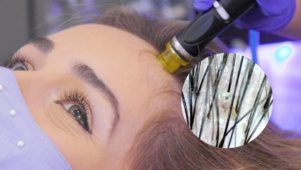 Remove scalp gunk with HydraFacial Keravive