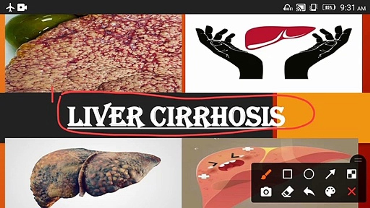LIVER CIRRHOSIS | FATTY LIVER | LIVER DISORDER CAUSES OF FATTY LIVER | PREVENTION OF LIVER CIRRHOSIS |