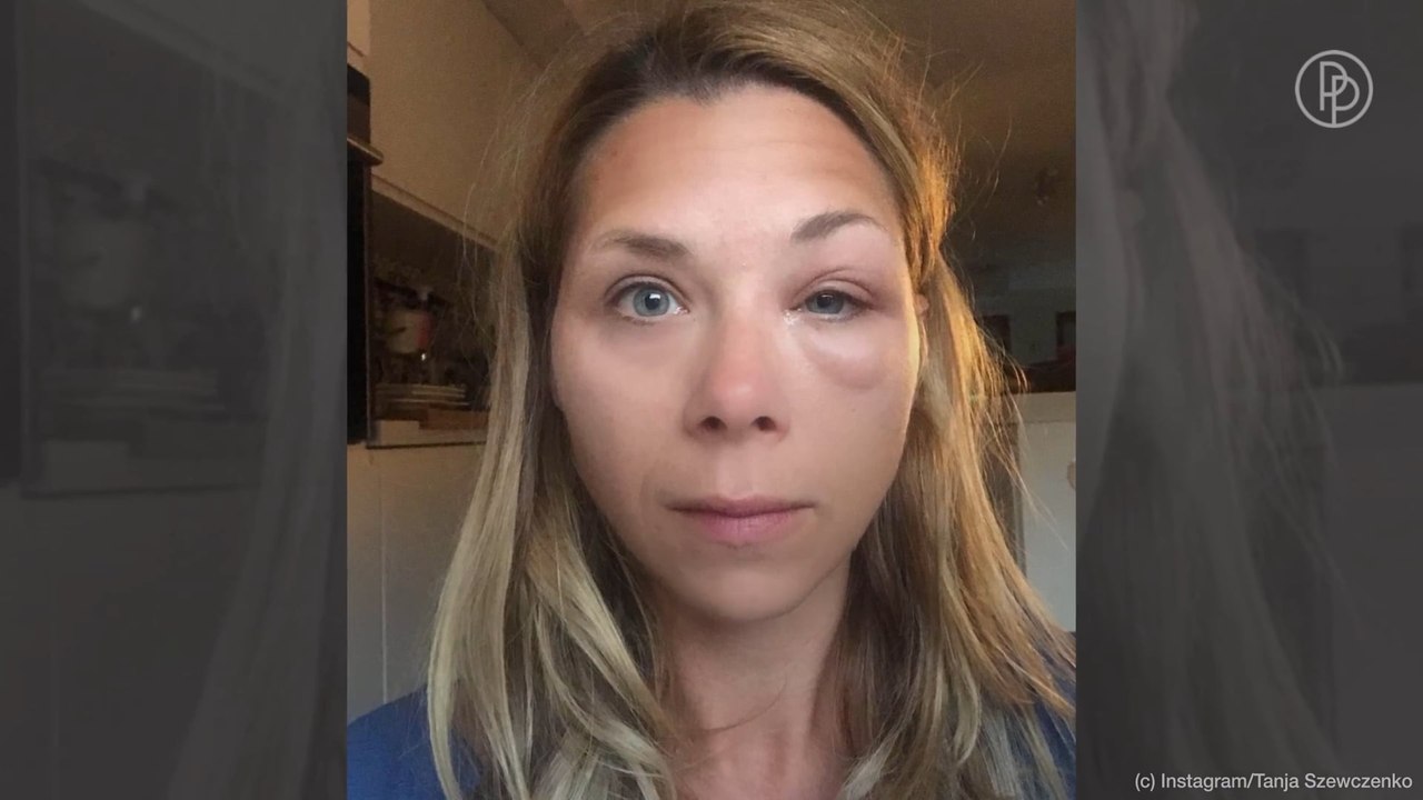 Krass: Tanja Szewczenko heftig von Wespe gestochen