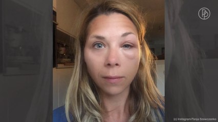 Krass: Tanja Szewczenko heftig von Wespe gestochen