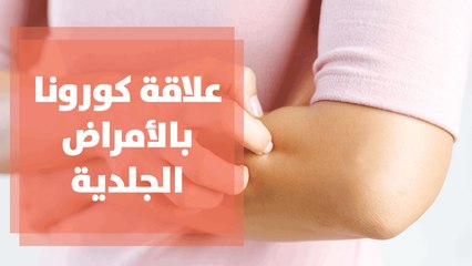 علاقة فيروس الكورونا بالأمراض الجلدية..التفاصيل مع د. ألينا السلمان