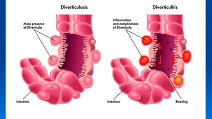 bd-diverticulos-y-sus-peligros-181220