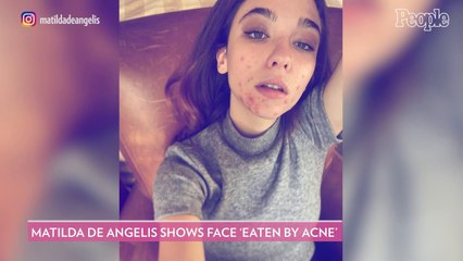 The Undoing’s Matilda De Angelis Shares an Unfiltered Photo of Her ‘Face Eaten by Acne’