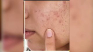Remove Dark Spots, Brown Spots & Get Clear Smooth Skin,