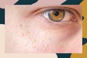 What Is Milia? Dermatologists Explain Everything to Know About Those Tiny White Bumps