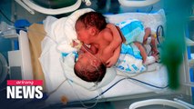 Yemeni conjoined twins await surgery amid poor medical resources in the country