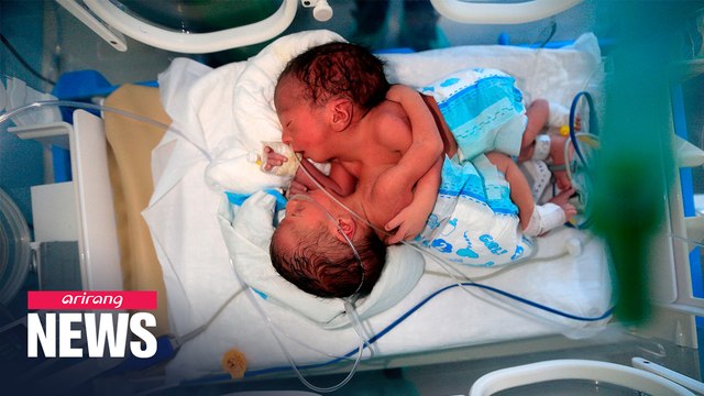 Yemeni conjoined twins await surgery amid poor medical resources in the country