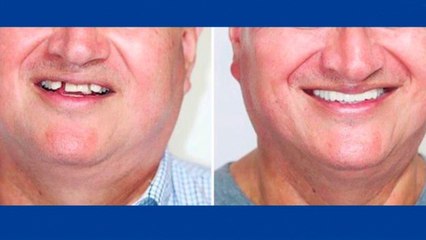 bd-practicas-diarias-que-producen-caries-231220