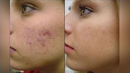 रातों रात के जिद्दी पिंपल को नैचुरल तरीके से करें दूर। Powerful Natural Remedies For Pimple Removal