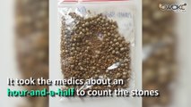 In world's third case, doctors remove 2215 stones from man's gall bladder