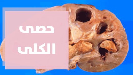 التغذية المناسبة لحصى الكلى