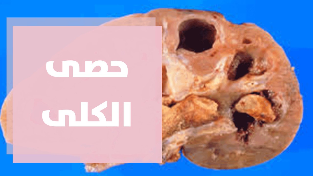 التغذية المناسبة لحصى الكلى