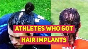 Athletes who got hair implants
