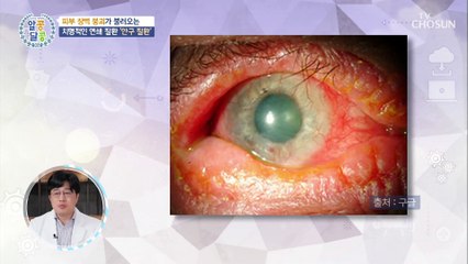아토피 피부염이 안구질환을 유발한다?! #광고포함