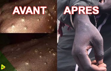 Maladie mystérieuse : Voici à quoi ressemblent les pêcheurs contaminés et désormais guéris