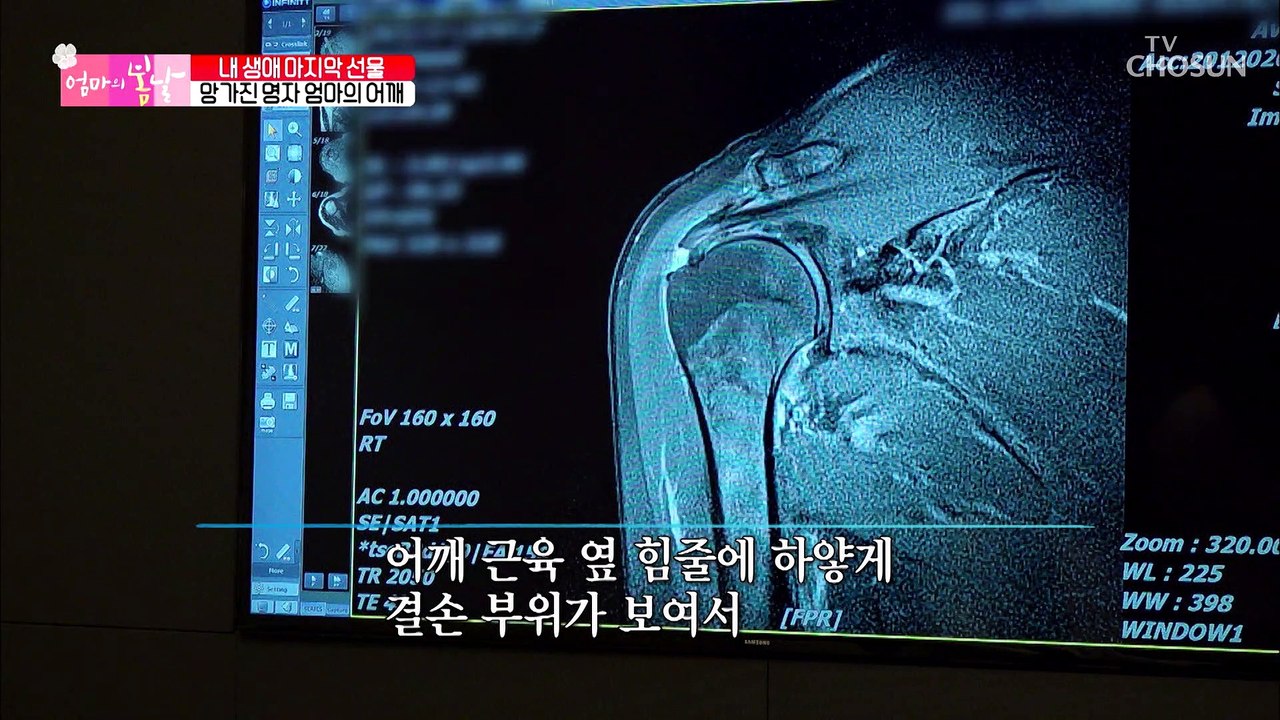 (걱정) 심각한 엄마의 어깨 상태.. 수술 후 상태는? TV CHOSUN 202101...