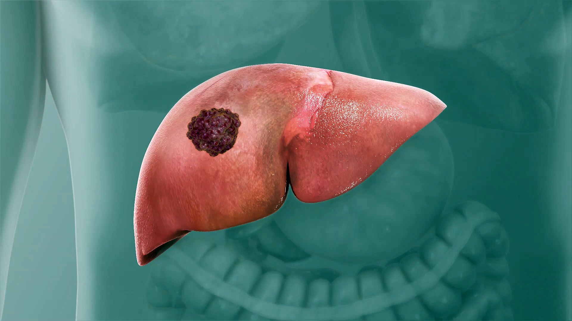What Is Liver Cancer