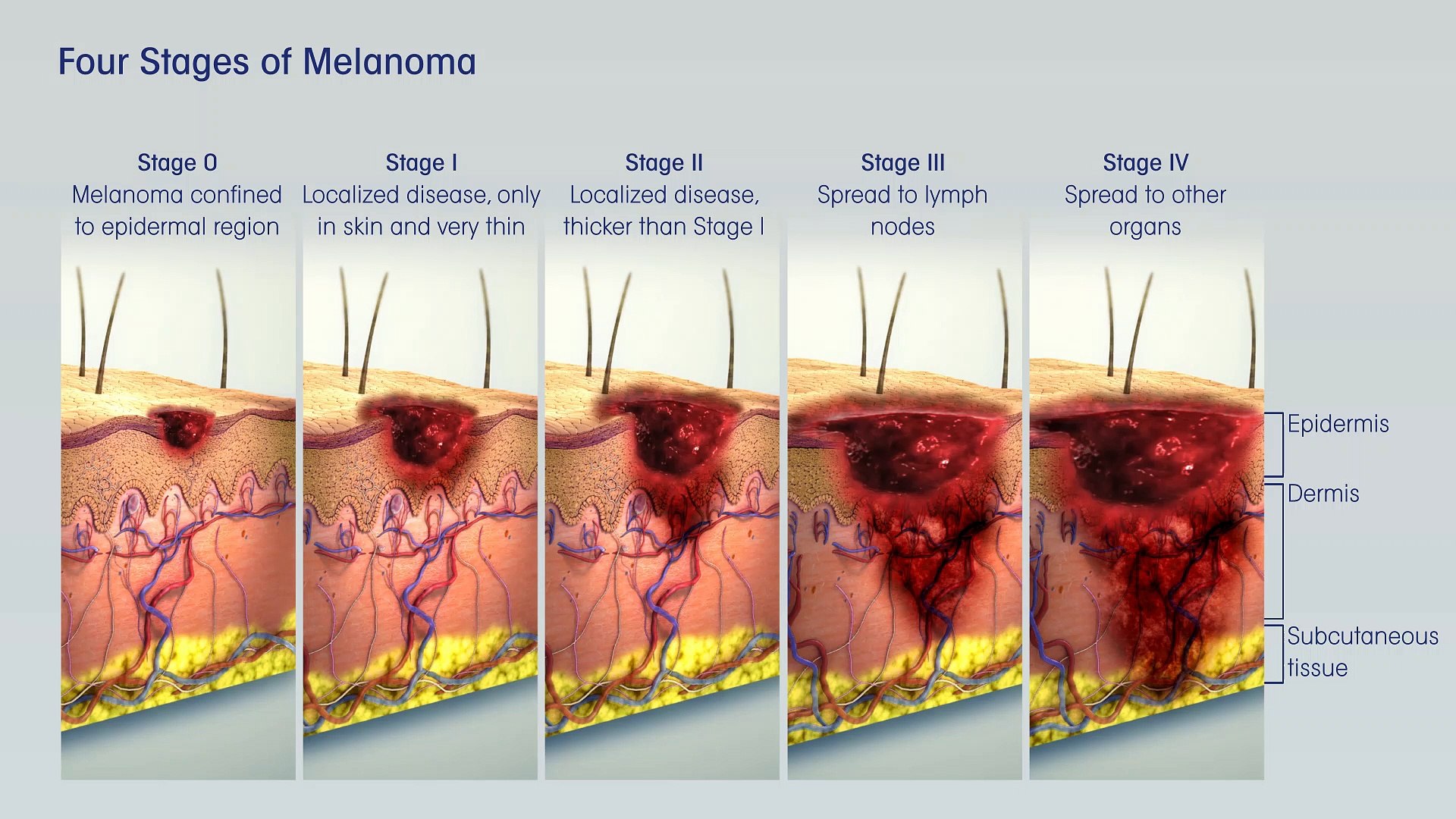 Treatment Of Melanoma Skin Cancer By Stage - Video Dailymotion