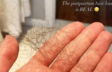 Lea Michele has postpartum hair loss