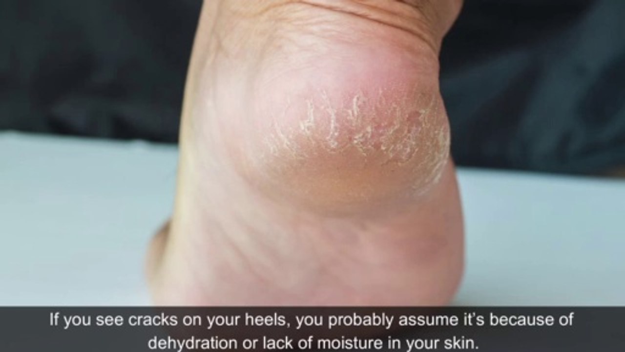 Why You May Get Cracked Heels and How to Fix Them Naturally