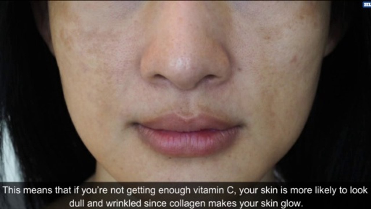 10 Early Signs Your Body Is Running Out of Vitamin C 