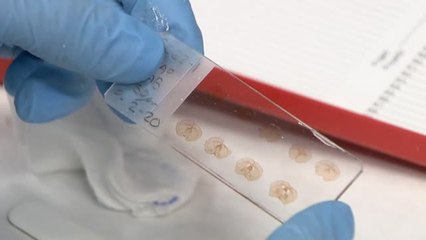 Ultrasonidos para combatir el Parkinson, un tratamiento pionero sin necesidad de cirugía