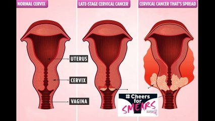What Is Cervical Cancer