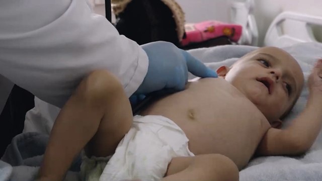 معاناة الأطفال في شمال غربي سوريا من التقزم بسبب سوء التغذية
