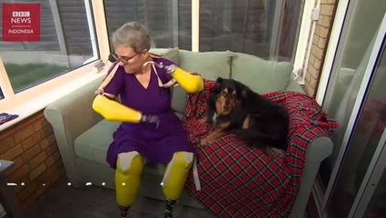 Perempuan Ini Harus Rela  kehilangan tangan dan kaki karena Covid-19