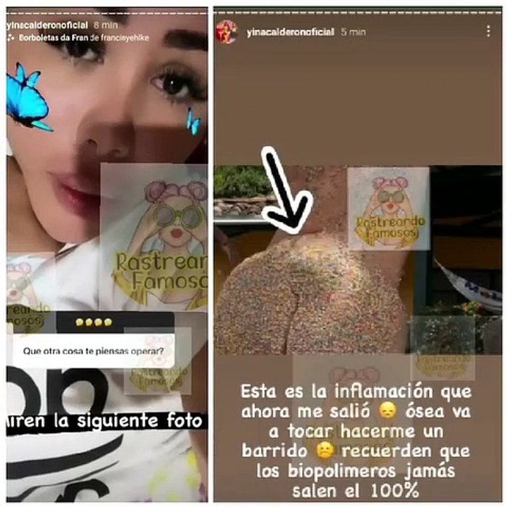 Yina Calderón contó que tendrá que ser operada por biopolímeros