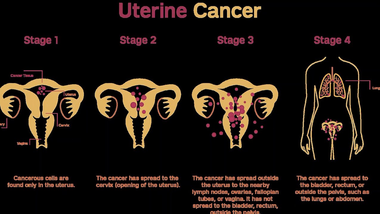 Treatment Choices for Endometrial Cancer by Stage
